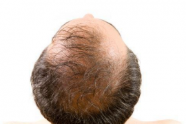 干细胞疗法破解头发再生的难题