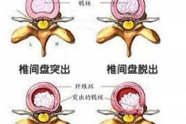 腰椎间盘突出怎么办？牛骨髓肽对腰椎间盘突有什么作用？