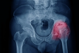 干细胞疗法对股骨头坏死的作用，65例治疗案例