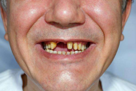 骨髓退化与牙龈萎缩的关系，补骨髓牙齿养护