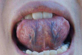 舌下青筋粗对健康的影响大吗?