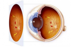 糖尿病视网膜病变前期有什么表现，糖尿病对眼部的损伤有哪些