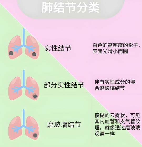 肺结节2.png