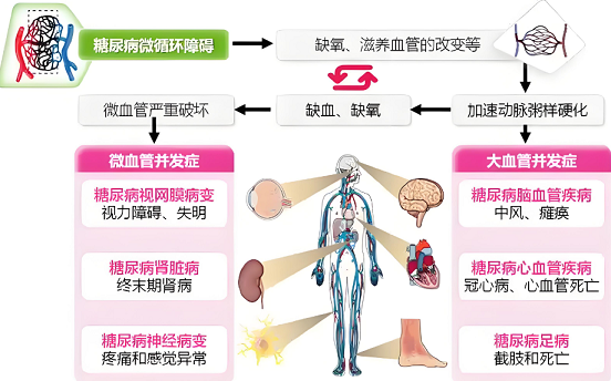 糖尿病微循环障碍.png